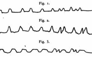 Diagram of 3 wavy lines labeled "figure 1" through "figure 3" intended to depict different measurements of syllable durations made by "linking the kymograph to the lips."